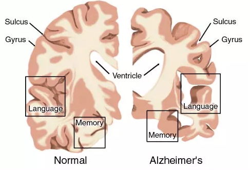 AD药物研发现状：辉瑞、礼来、百健、诺华、强生……