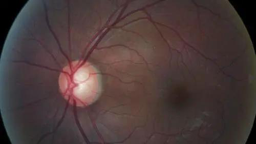 青光眼的克星来袭，助力患者远离视力的“窃贼”