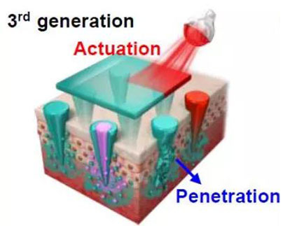 第三代：通过微针介导的皮肤层破坏和微针伴随的各种功能增强药物转运.jpg